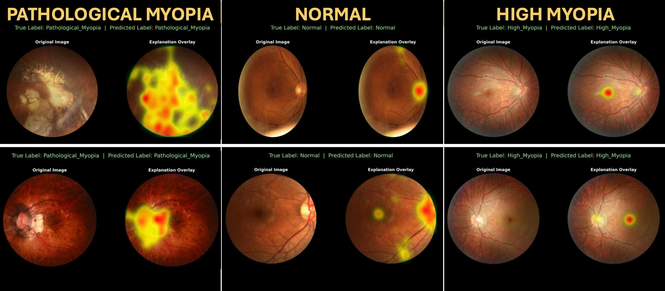 Myopia Classification Results